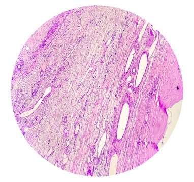 Cervical lymph node cytology: Lymphoproliferative disorder favor Non-Hodgkin's lymphoma. Smear show cellular material of monotonous population of atypical lymphocytes
