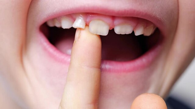 Boy touches a crooked milk tooth, close-up macro shot.