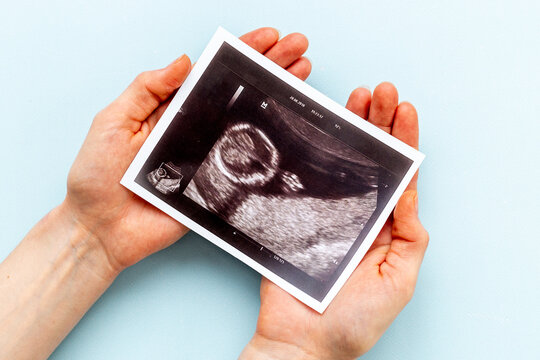 Sonography pregnancy picture of embryo in wonams hands