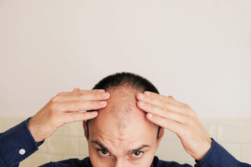 Fototapeta premium Young caucasian man looking at mirror worried about balding, close up. Baldness, alopecia in males, male pattern hair loss problem concept. Copy space for text.