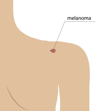 Schematic image of melanoma on the skin, changes in the shape and color of moles on the body