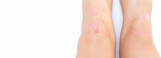 Knee joint effusion (water on knee) Acute psoriatic arthritis, osteoarthritis, meniscus tear. Excess synovial fluid in and around the knee joint.Banner for healthcare concept