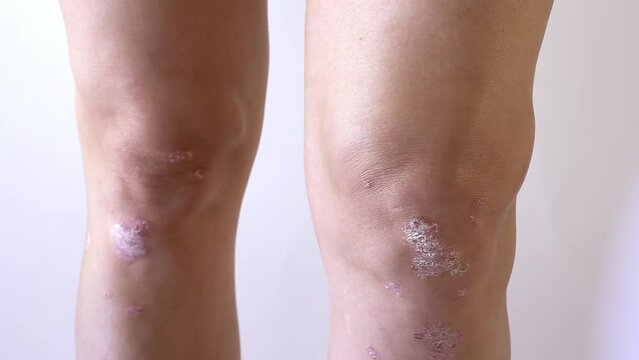 Knee joint effusion , water on the knee.Acute psoriatic arthritis, arthrosis ,meniscus injury.Excess synovial fluid in and around the left knee joint