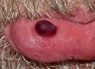 Blood blister isolated on bottom lip of caucasian male, framed with mustache and beard. Commonly...