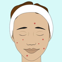 A girl's face in a hairband with acne (blackheads) on the skin