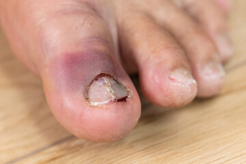 Bruise on toenail on left foot