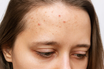 Close up of pimples on a forehead. Cropped shot of a young woman's face with acne problem. Allergies, rash, hormonal changes. Problem skin, care and beauty concept. Dermatology, cosmetology