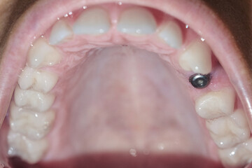 Obraz premium Close up of a real mouth with dental molar screw implant.