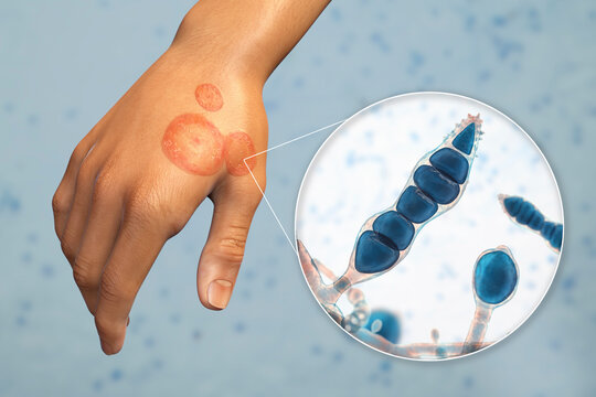 Fungal infection on a man's hand. Tinea manuum and close-up view of dermatophyte fungi