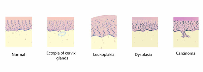 morphology of cervix pathology under a microscope, illustration, vector