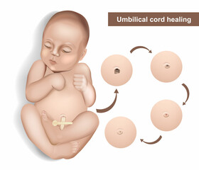 Umbilical cord care in newborns. Newborn umbilical cord stump falling off cycle. Dried stump of an umbilical cord of a newborn baby. Umbilical cord healing
