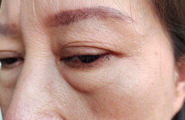 close up flabbiness adipose hanging under the eye, problem cellulite wrinkles beside the face of the woman, concept health care.