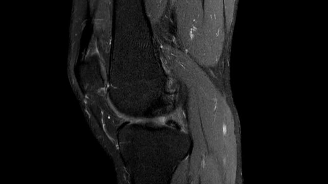 Dynamic scrolling through MRI images of knee joint. Diagnosis sport trauma and damage of ligaments. Magnetic resonance imaging of right knee.