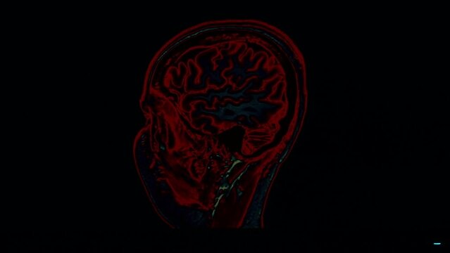 Brain magnetic resonances imaging. Blue and red colur. Amazing brain. Covid Brain. Covid 19 Brain change