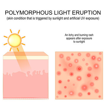 Polymorphic light eruption.