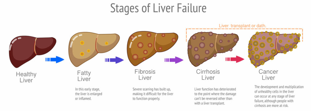 Hepatocellular Images – Browse 462 Stock Photos, Vectors, and Video ...