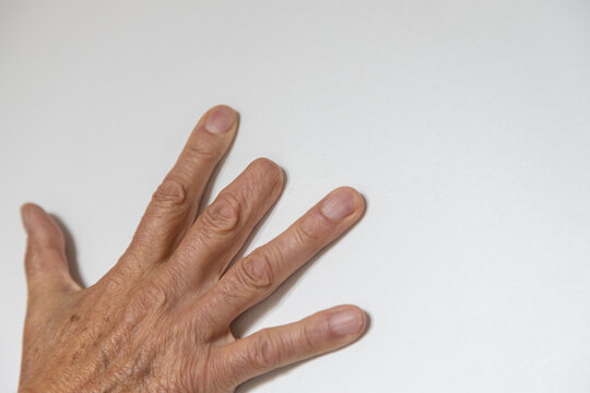 Close-up of a male right hand with amputated middle finger on white background