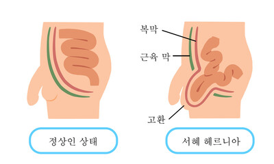 서경헤르니아 탈장의 일러스트