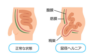 鼠径ヘルニア　脱腸のイラスト