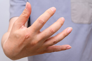 Hands of men suffering from finger joint pain. Causes of rheumatoid arthritis, gout. Health care...