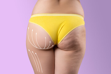 Overweight woman with fat cellulite legs and buttocks, before after concept, obesity female body with painted surgical lines and arrows - obrazy, fototapety, plakaty