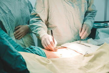 Medicine.Surgeon doctor makes laparoscopy operation.Modern medicine,close-up,operating room.Doctor,hands