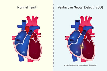 The difference of normal heart and ventricular septal defect (VSD) vector. Congenital heart defect. - obrazy, fototapety, plakaty