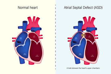 The difference of normal heart and atrial septal defect (ASD) vector. Congenital heart defect.
