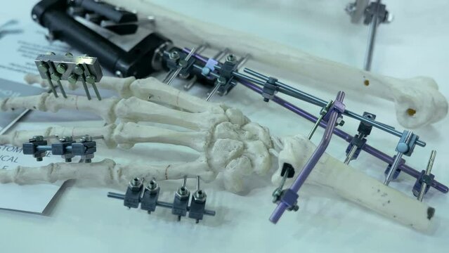 New high-tech proposals for the restoration of broken bones of the palm of the hand and forearm by means of frame devices, spokes with stops and screw rods. Close up. Shot in motion