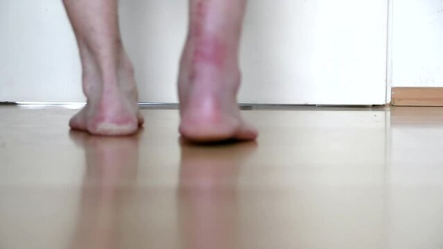 European man first steps after Achilles tendon rupture operation shows wound suture in the hospital showing stitches and operation transection walks barefoot with pain and partial weight bearing PWB