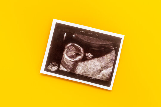 Ultrasound picture of unborn baby - pregnancy concept
