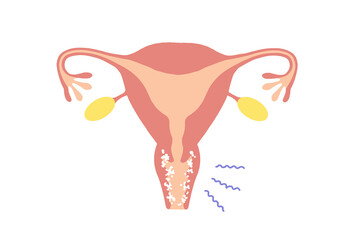 vaginitis Clip art of diseased uterus