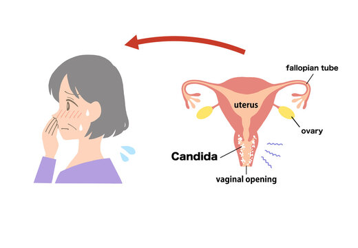 vaginitis Clip art of diseased uterus