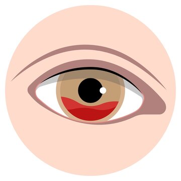 Hyphemas red eye bleeding injury and cause pain symptoms sickle cell exam