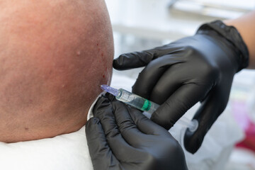 Cosmetologist makes prp therapy against baldness and hair loss to a bald man in a beauty salon. Plasma lifting procedure against baldness injection in the head. Cosmetology