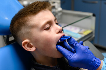 Jaw impression with a silicone diagnostic model, crooked teeth in a child.