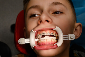 Visit to the orthodontist, installation of braces on the upper teeth, white retractor on the lips...