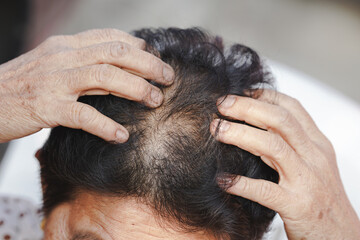 Elderly women have thinning hair due to hair loss.