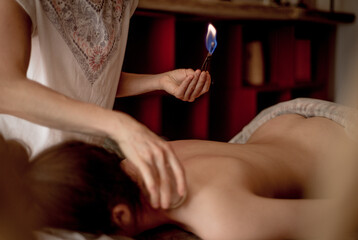 Detail of an acupuncture therapist placing a glass globe in a fire cupping procedure, chinese...