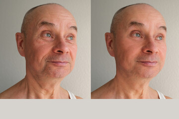 Before and after cosmetic operation. close-up of face of old man, senior with wrinkles on his face...