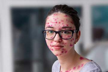 Chickenpox adult girl covered in skin inflammation.