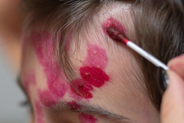 The skin rash in a child is treated with a cotton swab. Chickenpox virus. Skin rash and blisters on...
