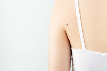 Dark brown moles on woman back skin. Awareness of changes in your moles to detecting skin cancer,...