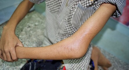 Supracondylar fracture or broken elbow in Asian child. Fracture of distal humerus bone close to...