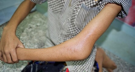 Supracondylar fracture or broken elbow in Asian child. Fracture of distal humerus bone close to...