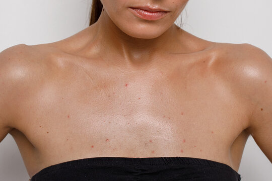 acne close-up on the female breast, problematic teenage skin