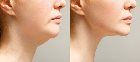 Female double chin before and after correction. Correction of the chin shape liposuction of the...