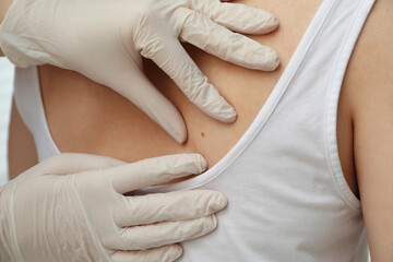 Dermatologist examining patient's birthmark in clinic, closeup view