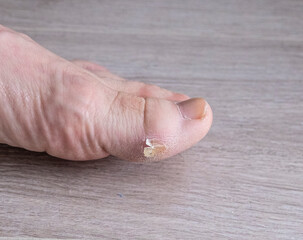 Callus on the big toe of a person, fair skin. close-up.