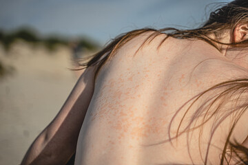 chronic skin disease on the back - obrazy, fototapety, plakaty